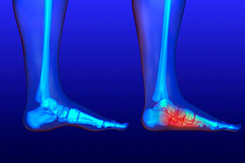 Flat feet and Fallen Arches treatment in Houston, TX 77095