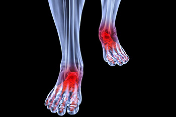 arthritic foot and ankle care treatment in the Houston, TX 77095 area