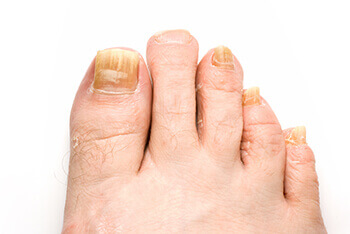 fungus toenails treatment in the Houston, TX 77095 area