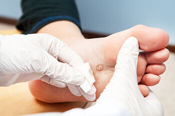 Plantar warts treatment in the Houston, TX & Cypress, TX 77433 areas