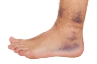 All About Ankle Sprains