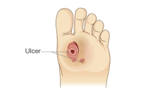 A Guide to Caring for Diabetic Foot Ulcers